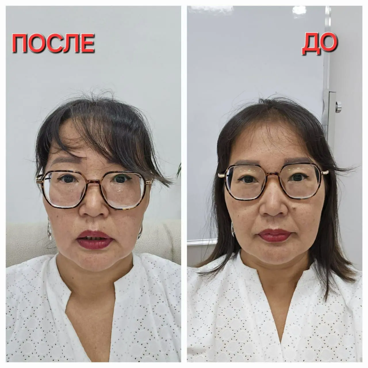 Результат после процедуры ВЭНТУН: фото До и После